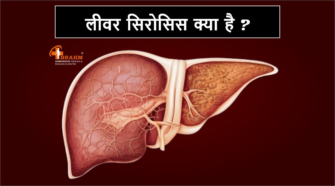 homeopathy me liver cirrhosis ka ilaaj