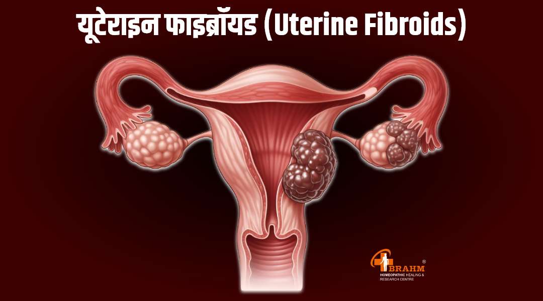 uterine fibroids ka homeopathy me ilaaj 