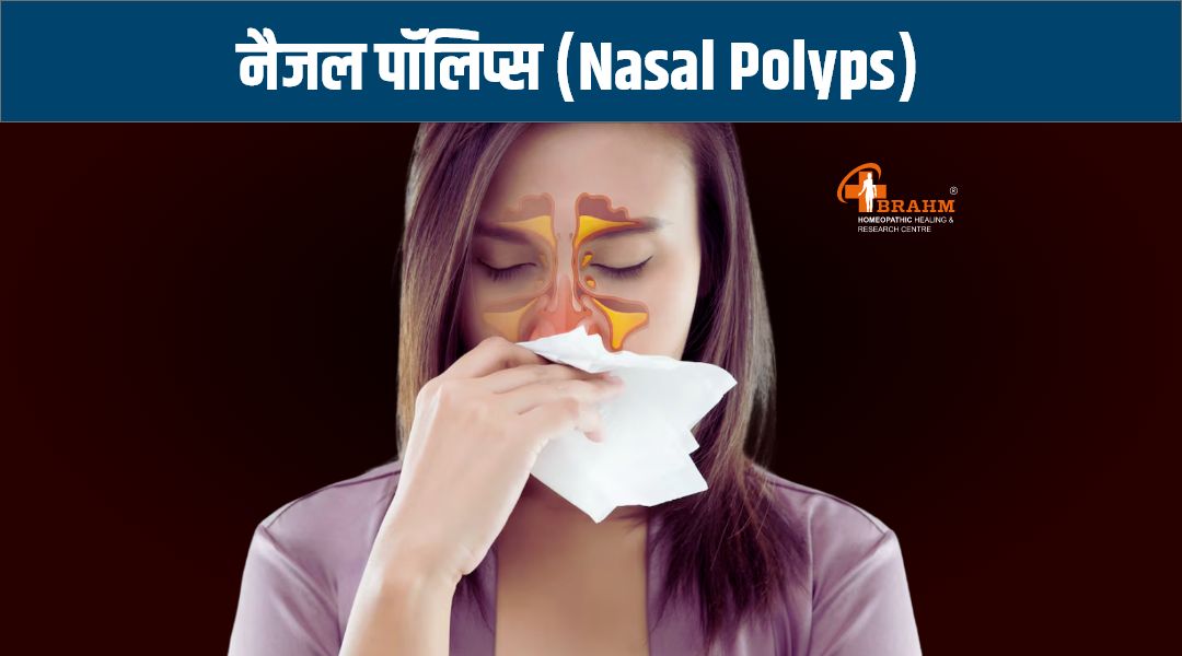 homeopathic me nasal polyps ka ilaaj