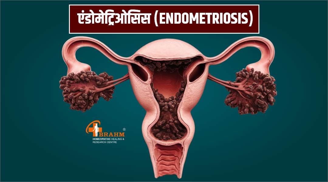 Endometriosis ka homeopathy me ilaaj
