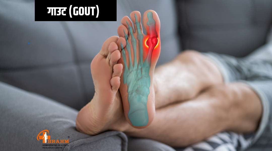 gout pain treatment in homeopathy