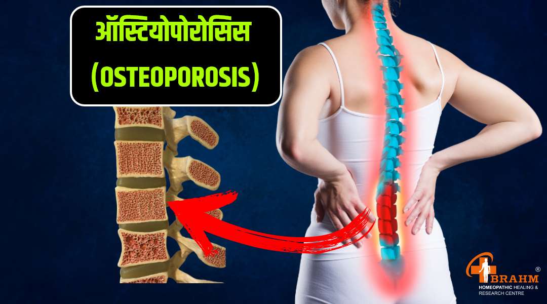 Osteoporosis ka homeopathy me ilaaj