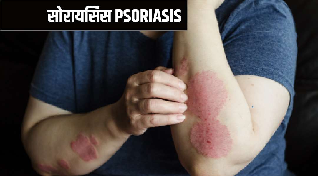 cirrhosis  ka homeopathy me ilaj  | cirrhosis kya hai 