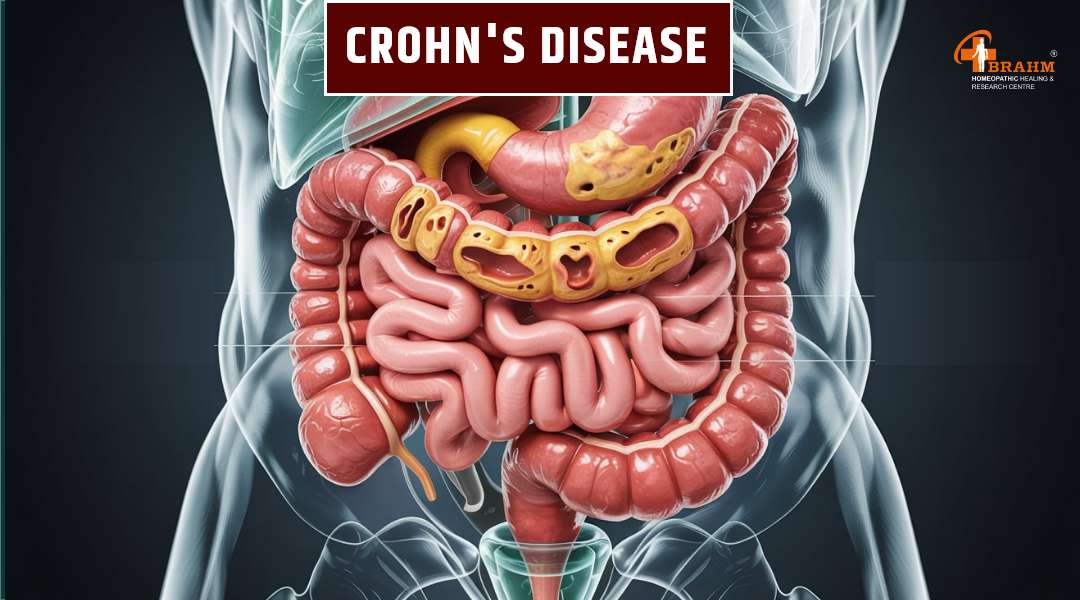 crohns bimari ka homeopathy me ilaaj
