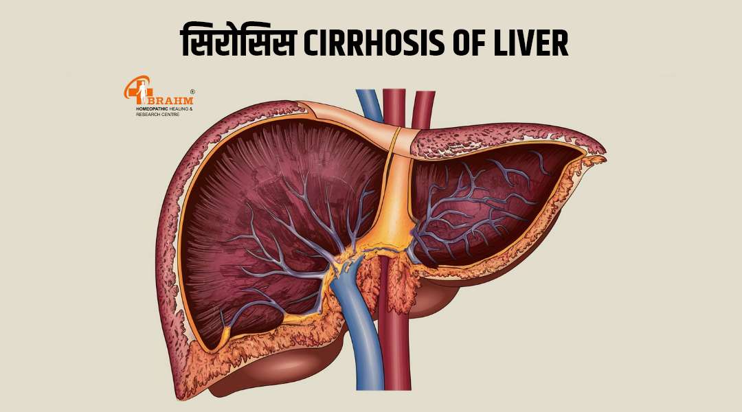 homeopathic me liver cirrhosis ka upchaar