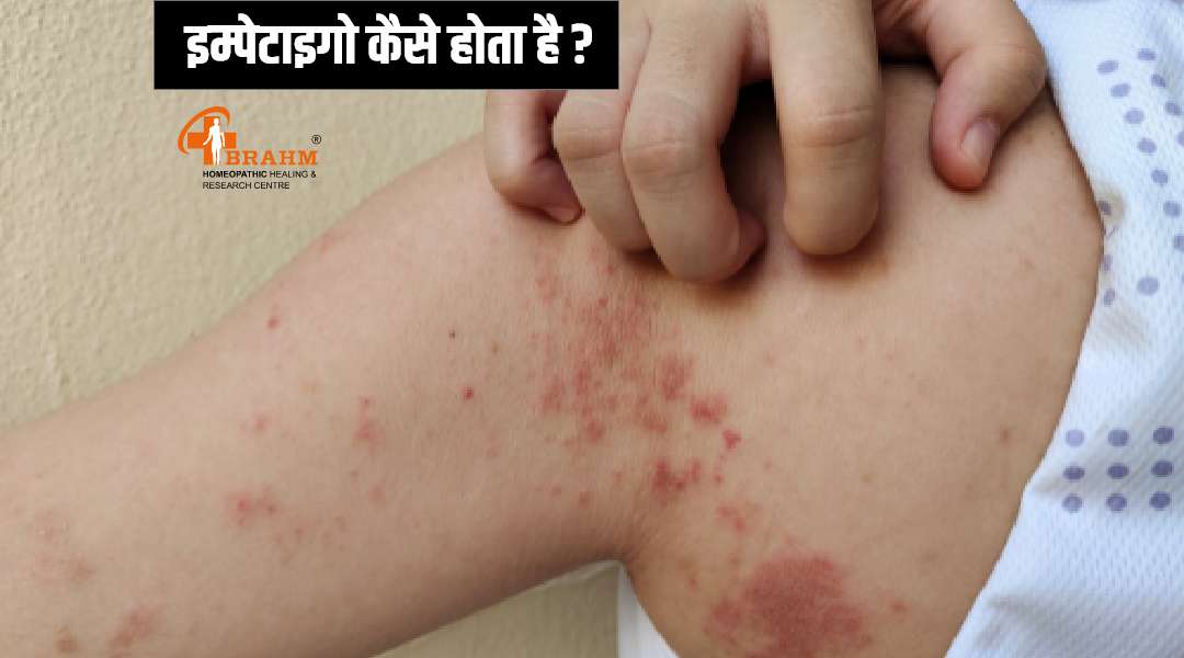 homeopathy Treatment for Impetigo | Impetigo treatment for babies 