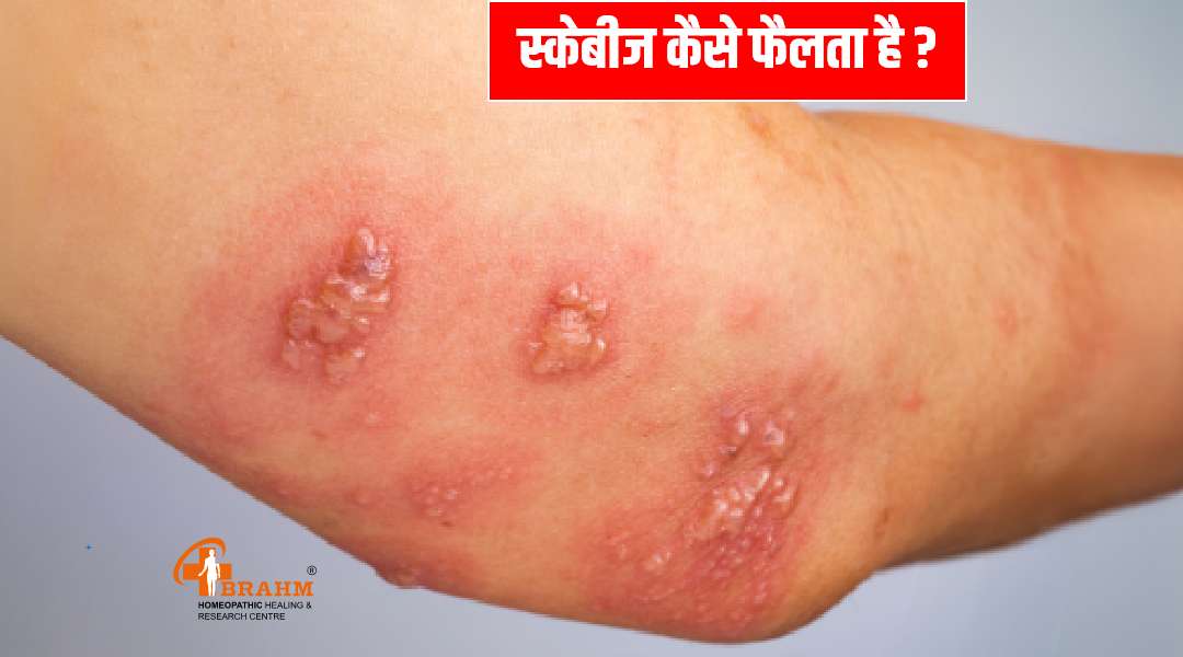 scabies ka homeopathic ilaj