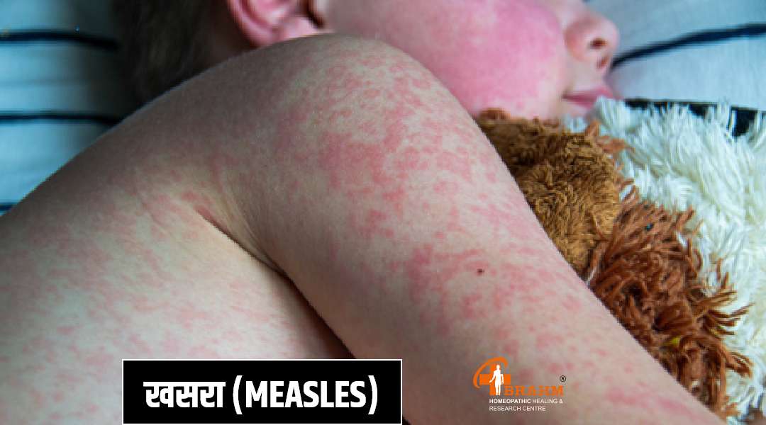 Measles ka treatment in hindi