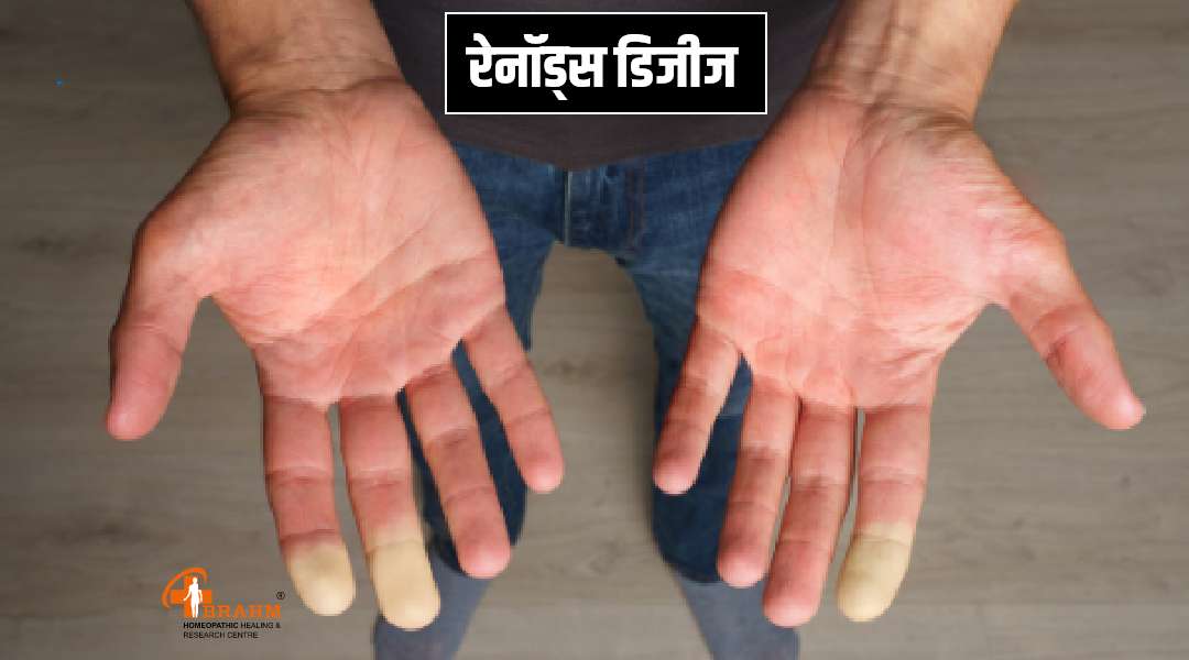raynaud's bimari ka laksan karan  ilaaj