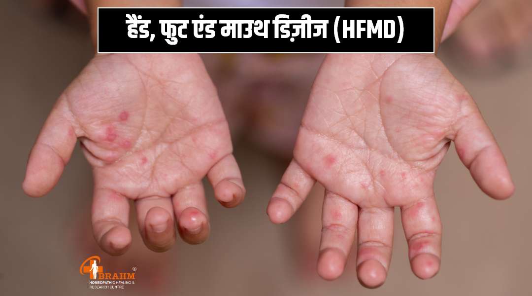hfmd bimari ka ilaaj