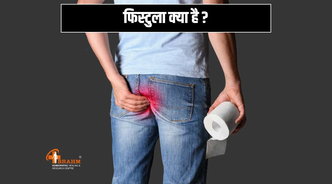 Fistula ka ilaaj | fistula treatment in homeopathy