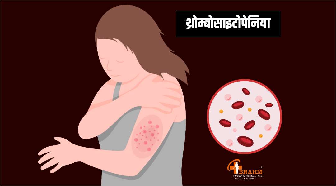 Thrombocytopenia ka ilaaj