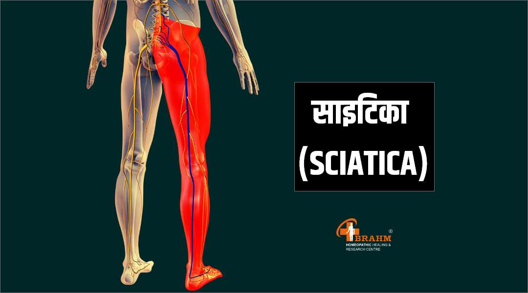 Sciatica ka homeopathic ilaj