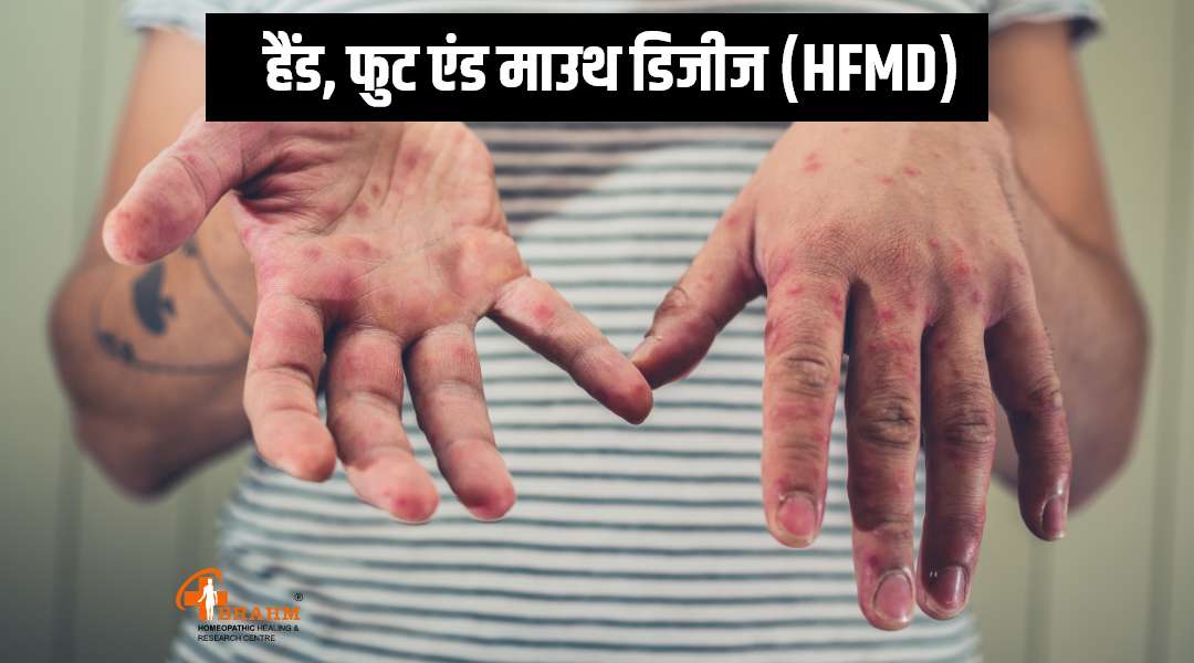 HFMD ka homeopathy me ilaaj