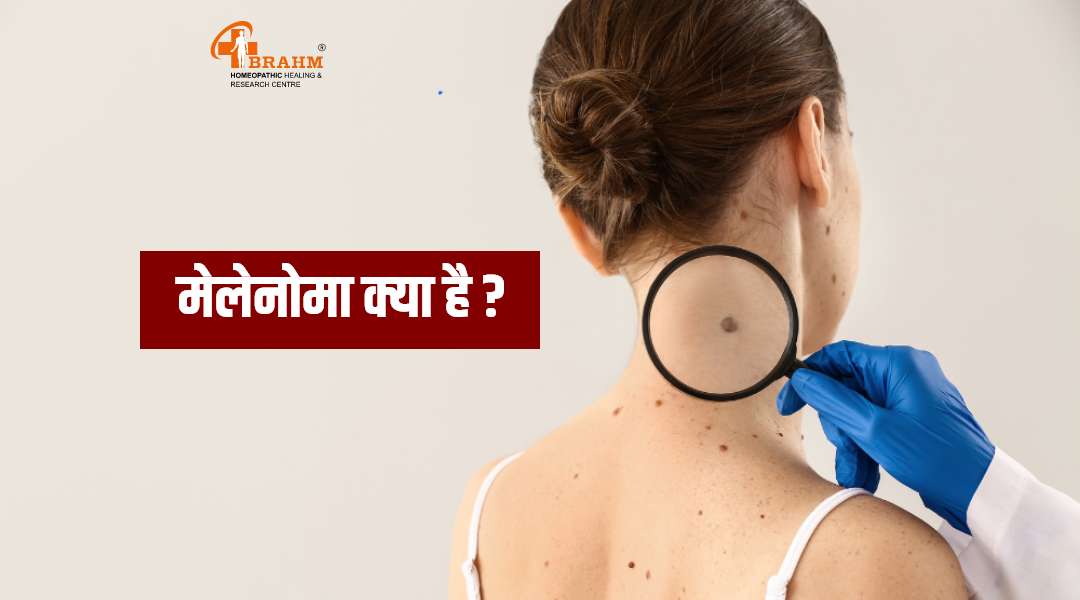 melanoma kya hai