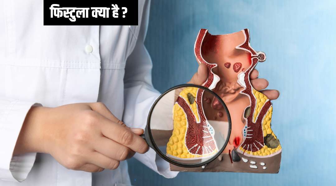 fistula treatment in homeopathic