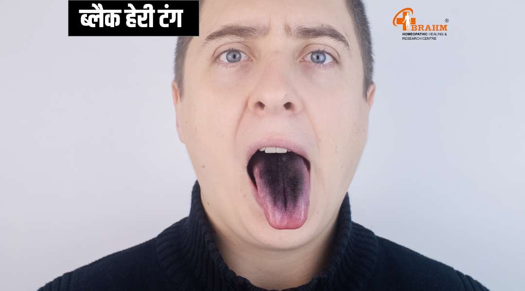 black hairy tongue treatment in homeopathy