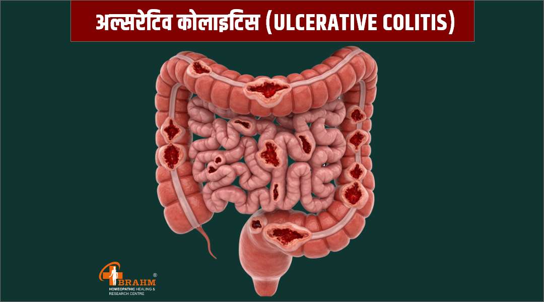 ulcerative colitis ka homeopathic me ilaaj 