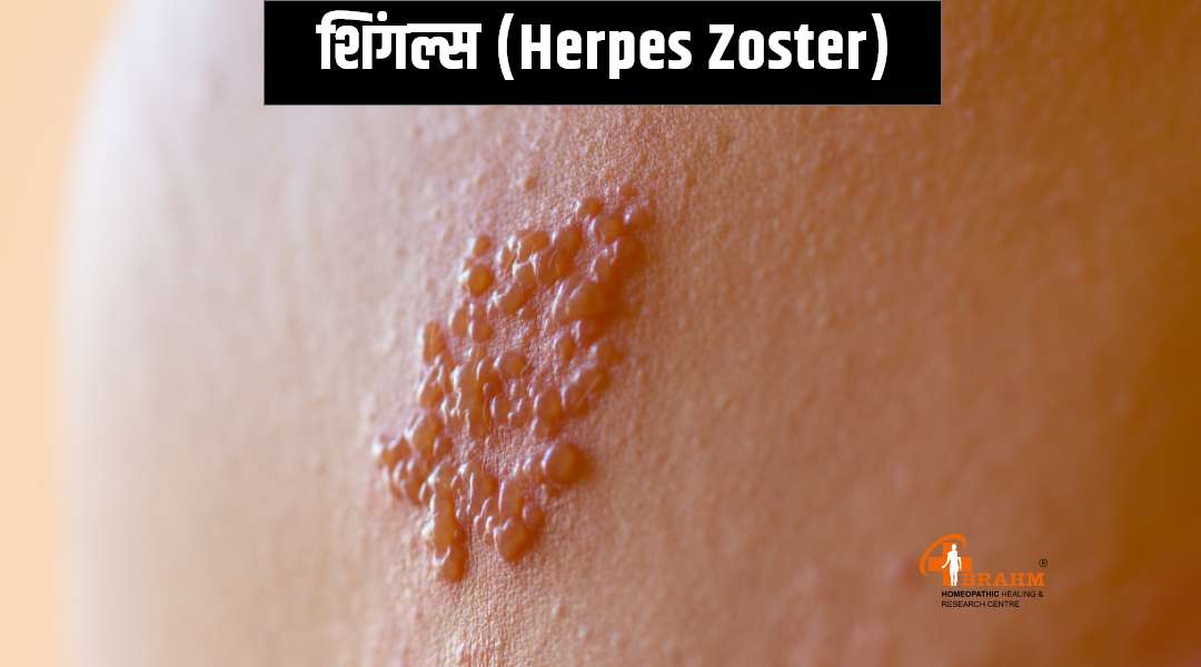 herpes zoster treatment in homeopathy