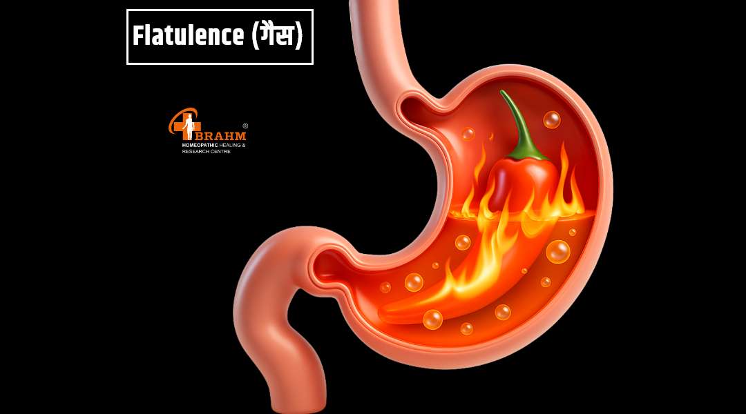 flatulence (gas) treatment in homeopathy