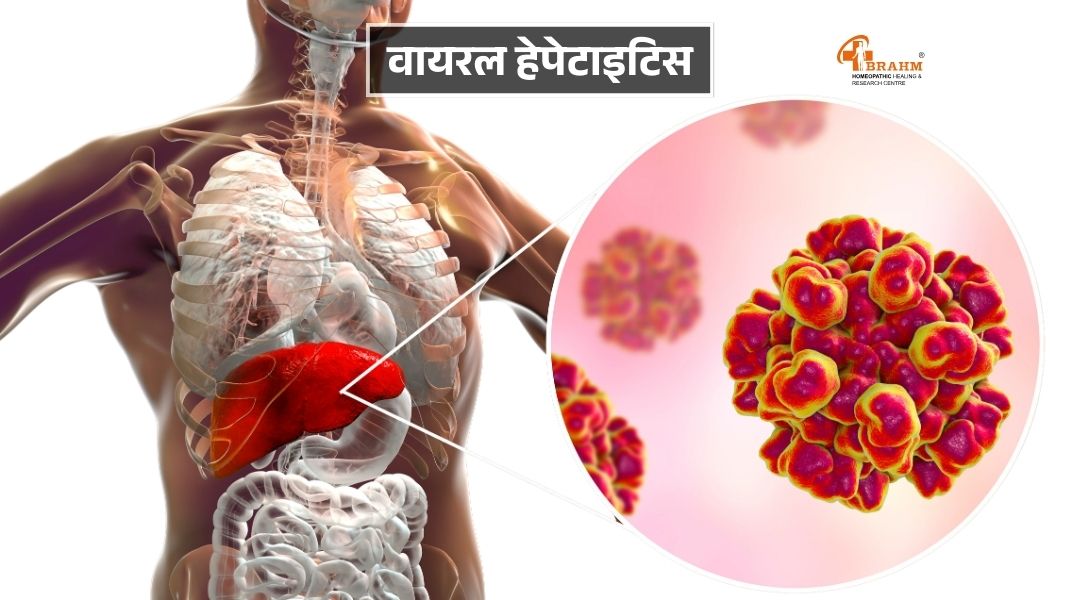 homeopathy me Viral Hepatitis ka ilaj