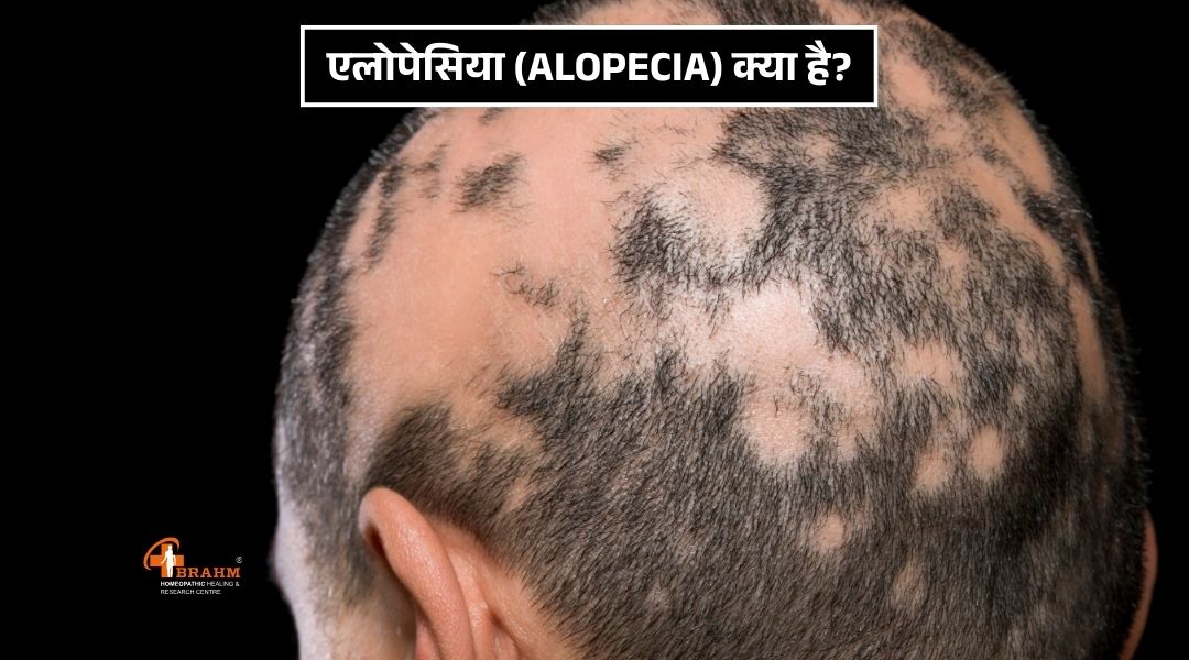 Alopecia bimari kya hai or kyu hoti hai?