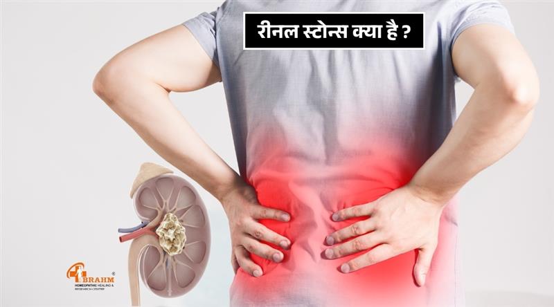 renal stone kya hai or kyu hota hai?