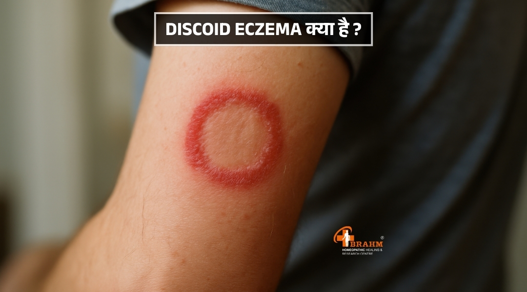Discoid Eczema treatment in homeopathic 