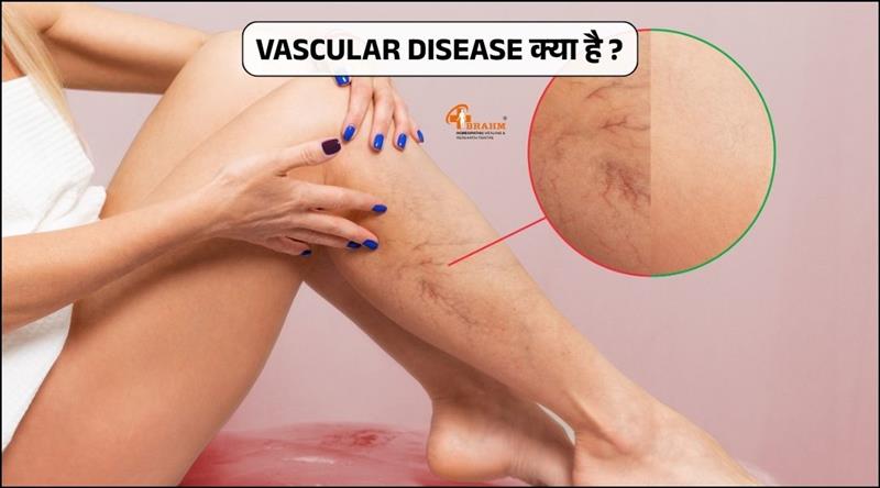 Vascular Disease kya hai or kaise hota hai?