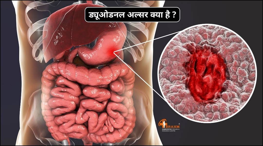 duodenal ulcer  kya hai or kyu hota hai?