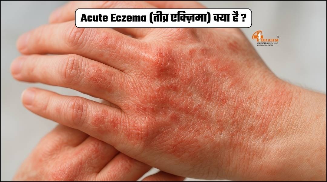 Acute Eczema  kya hai? or kaise hota hai?