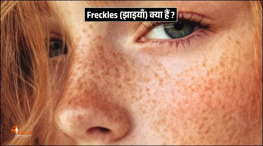 freckles kyu or kaise hote hai?