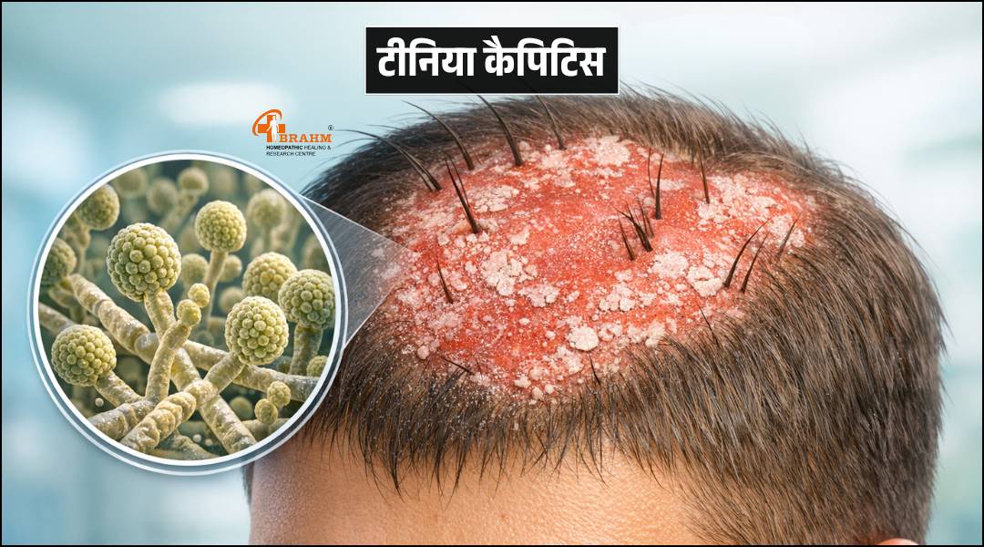 tinea capitis kya hota hai ? or kaise failta hai?