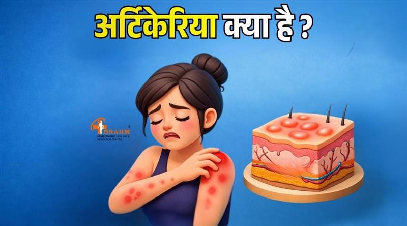 urticaria kya hai or kaise failta hai ?