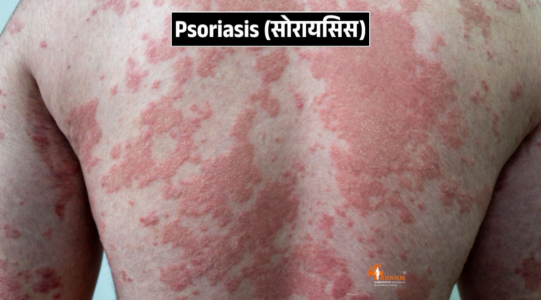 homeopathy me psoriasis rog ka kya ilaj hai? 