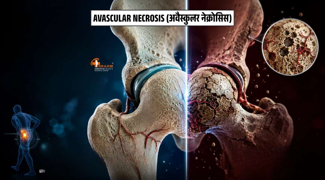 avn ka homeopathy me ilaj?