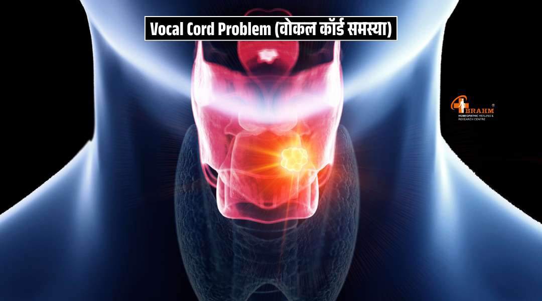 vocal cord problem ka homeopathy me ilaj?