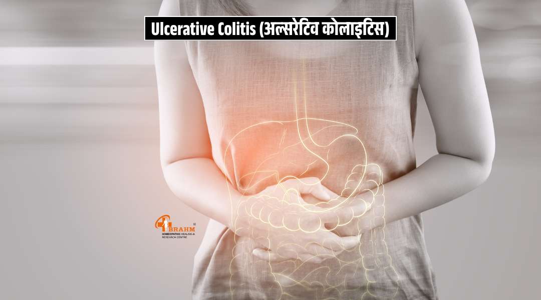 Ulcerative Colitis kya hai? or homeopathy me upchar?