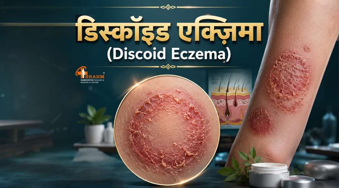 Discoid eczema kya hai?or kse hota hai?