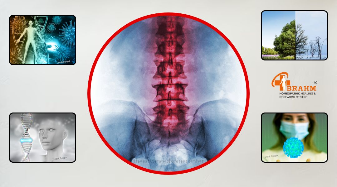 Causes-of-Ankylosing-spondylitis