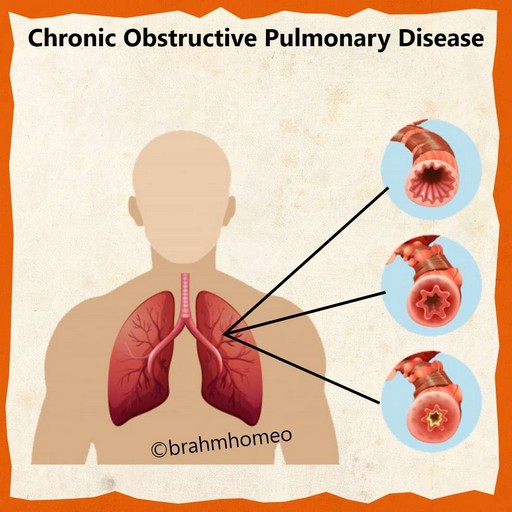 COPD-TREATMENT-IN-HOMEOPATHY