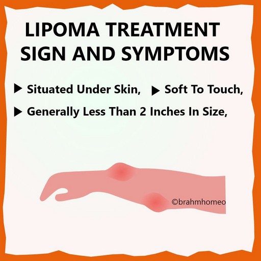 lipoma treatment