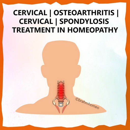 cervical-osteoarthritis-treatment-in-homeopathy