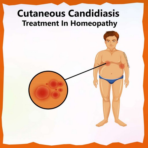 cutaneous-candidiasis-treatment-in-homeopathy