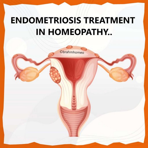 endometriosis-treatment-in-homeopathy