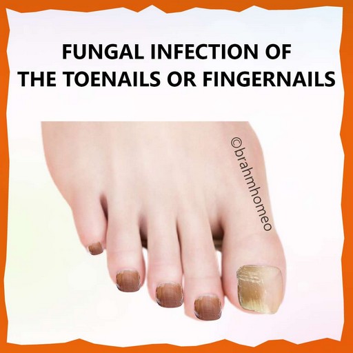 fungal-infection-of-the-toenails-or-fingernails