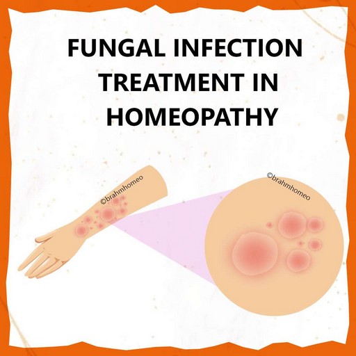 fungal-infection-treatment-in-homeopathy