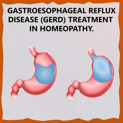 gerd-treatment-in-homeopathy