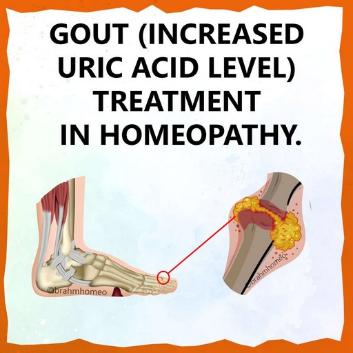 gout-treatment-in-homeopathy