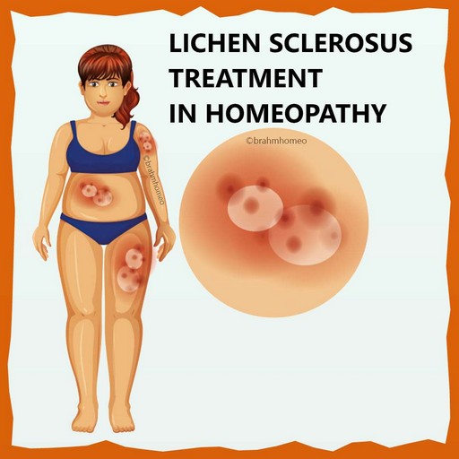 lichen-sclerosus-treatment-in-homeopathy